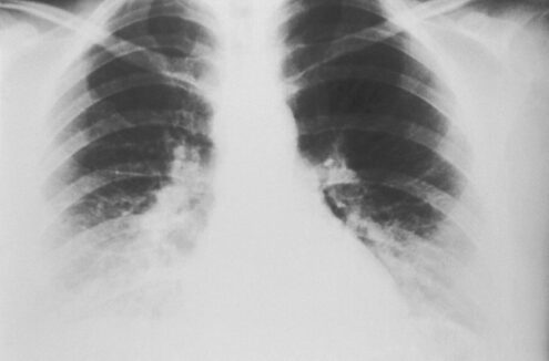 Frontal chest x-ray displaying lungs and heart.
